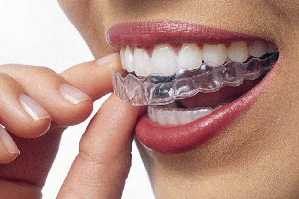 Aparelho Invisalign